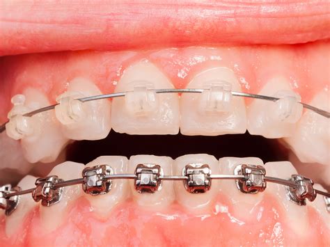 are ceramic brackets bigger than metal|ceramic braces vs silver brackets.